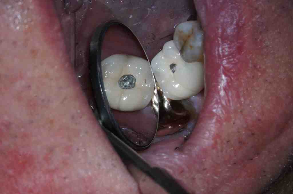 how-tight-should-dental-implant-crown-be-torqued-down-dental-news-network