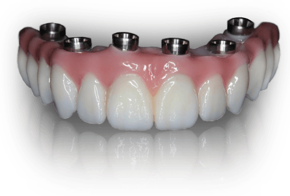 What does all on 4 dental implants mean?