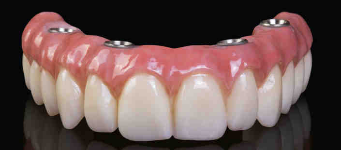 What insurance cover dental implants?