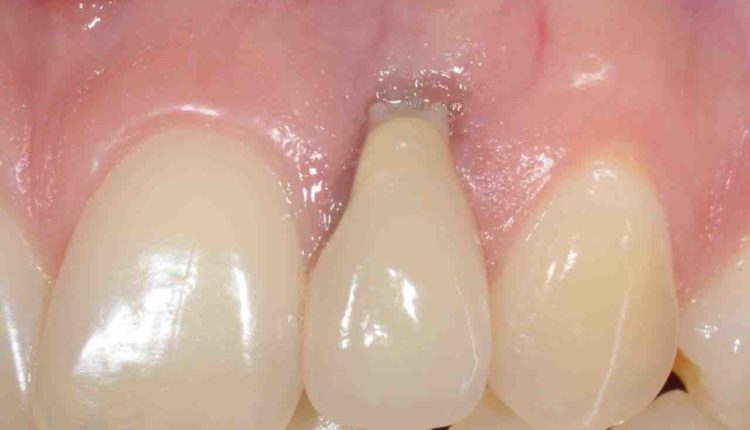 What is a dental implant