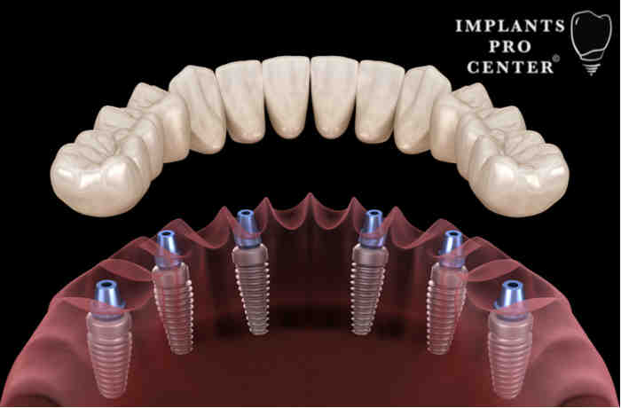 What is a reasonable price for dental implants?