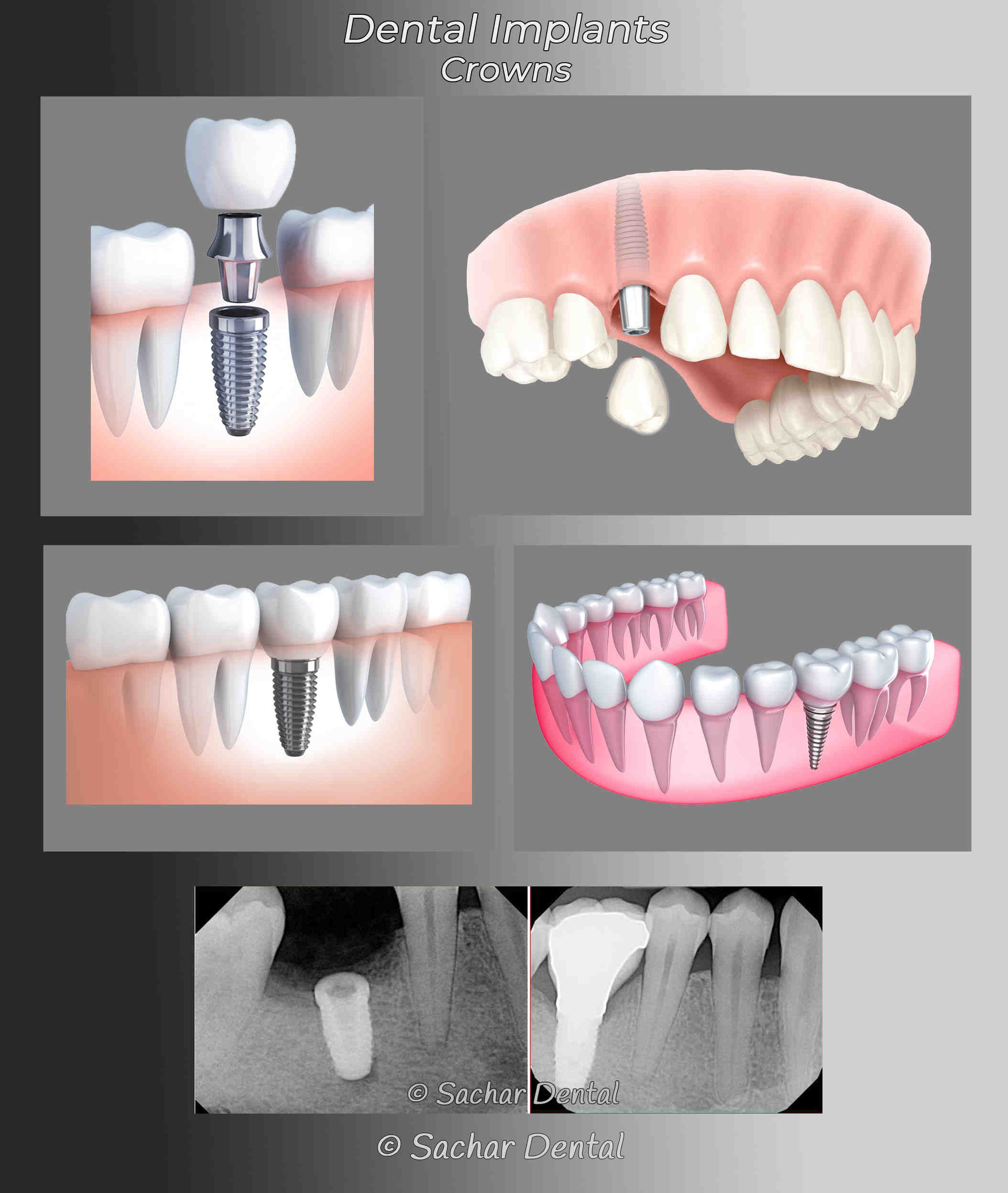 What is a reasonable price for dental implants?