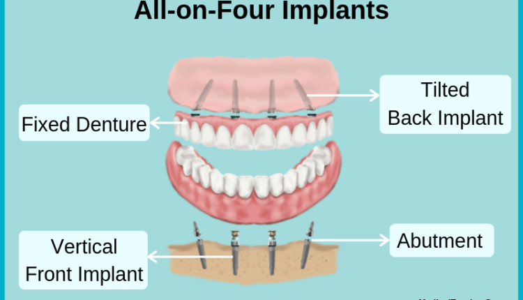 What is all on 4 dental implants
