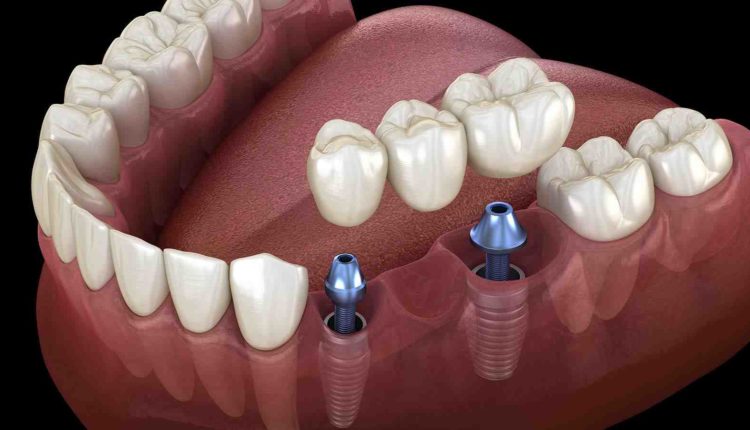 What is dental implant
