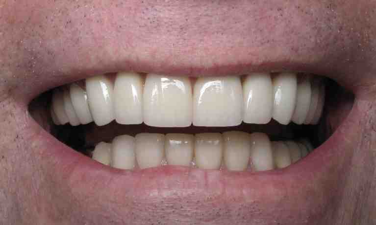 What is the average cost for dental Lumineers?