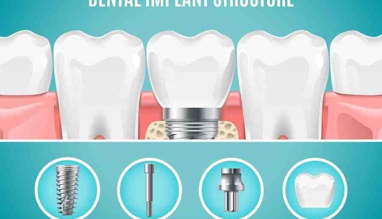 What is the average cost of a dental implant