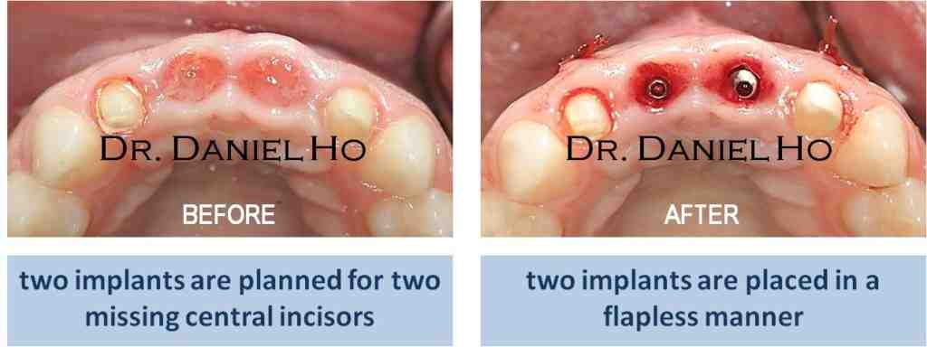 What is the best dental implant procedure?