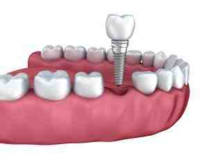 What is the cheapest tooth implant?