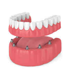 What is the cheapest tooth implant?