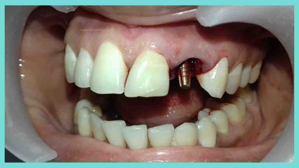 What is the downside of dental implants?