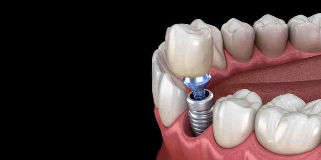 What is the downside of dental implants?