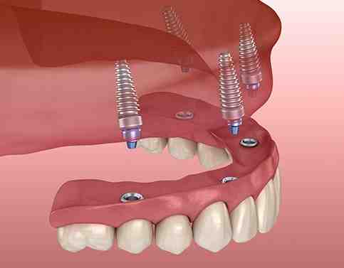 What is the downside of dental implants?