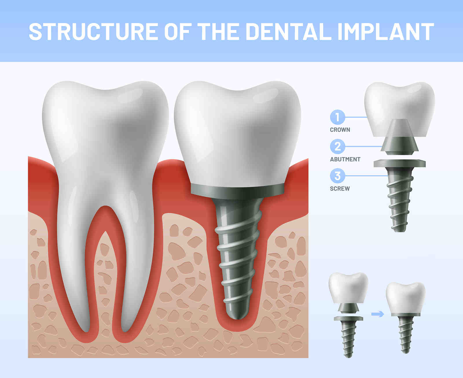 What is the downside of dental implants?