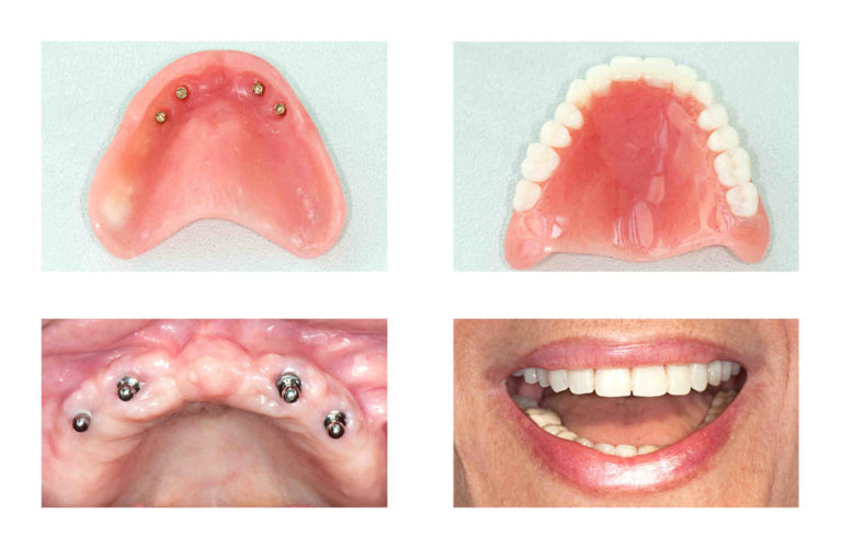 What Is The Average Cost Of Dental Implants Dental News Network