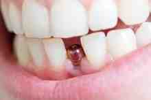 What is the downside of dental implants?