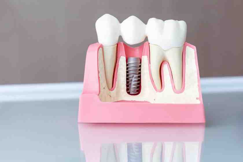 What is the downside of dental implants?