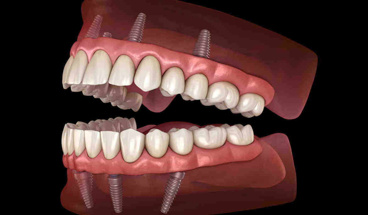What is the downside of dental implants?