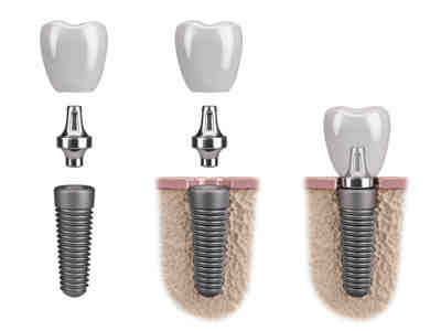 What is the downside of dental implants?