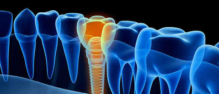What is the downside of dental implants?