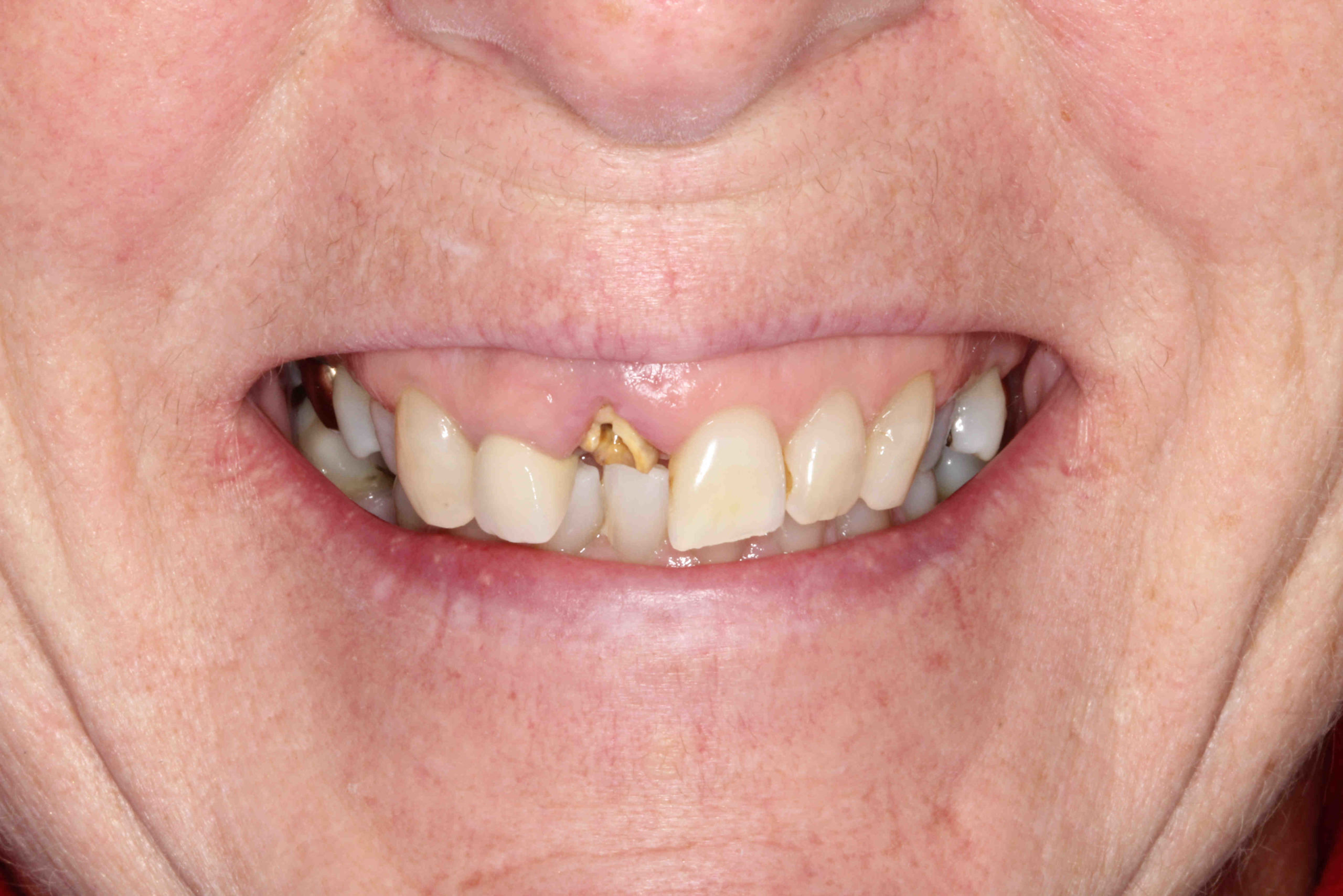 What is the downside of dental implants?