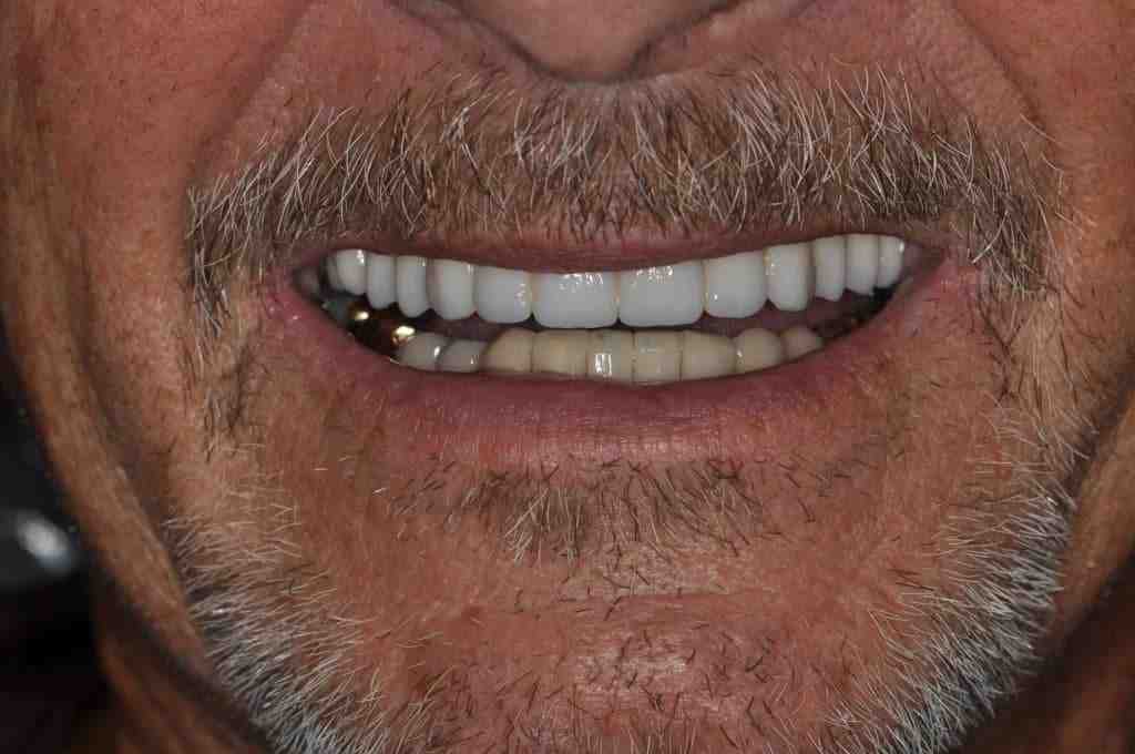 What is the downside of dental implants?