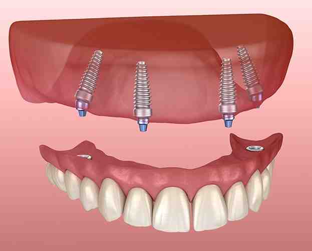What is the downside of dental implants?