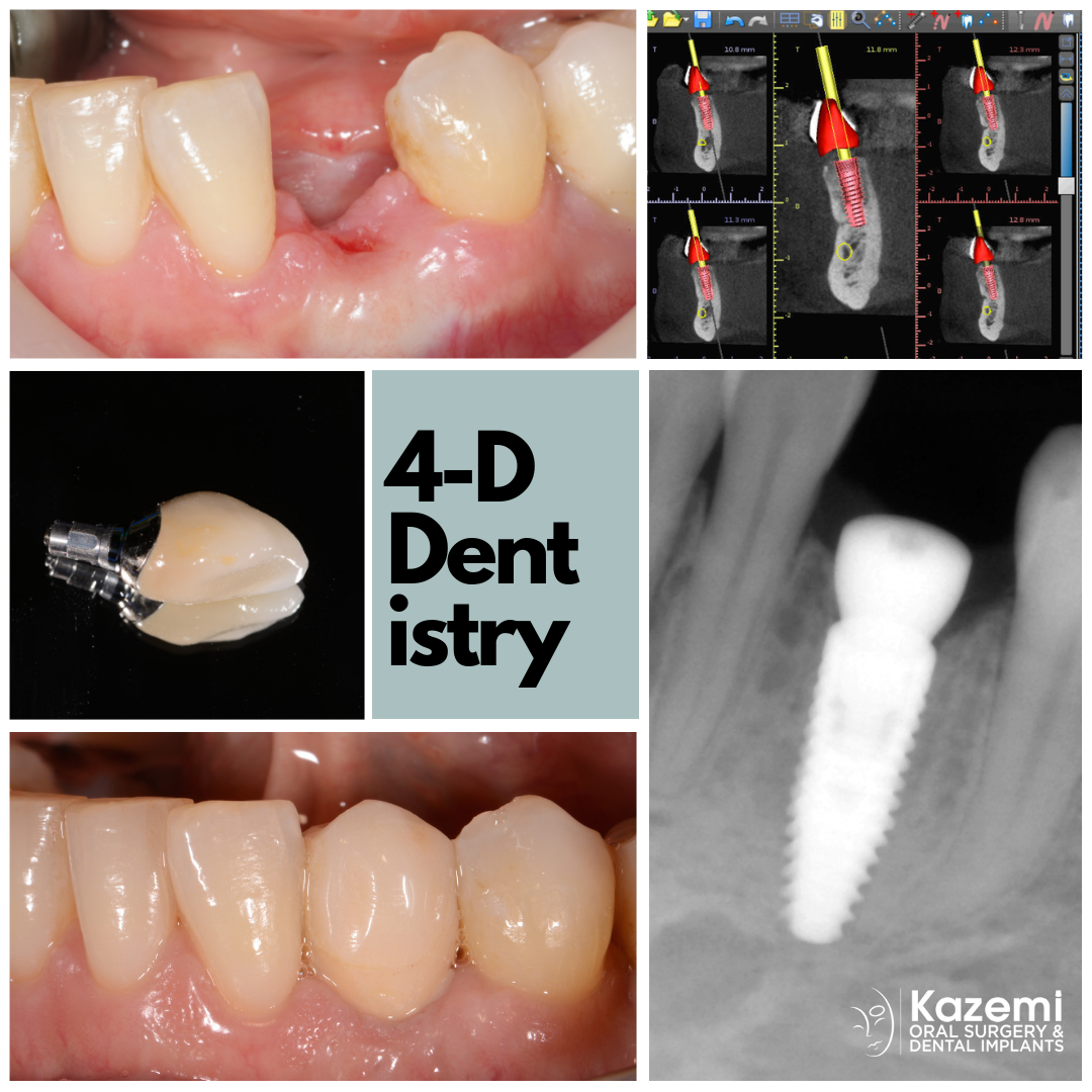 What is the failure rate of dental implants?