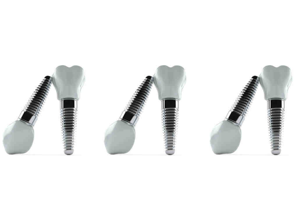 What materials are used in dental implants?