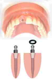 What to do if you can't afford dental implants?