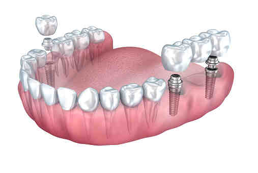 What to do when you can't afford dental implants?
