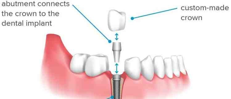 What to know about dental implants