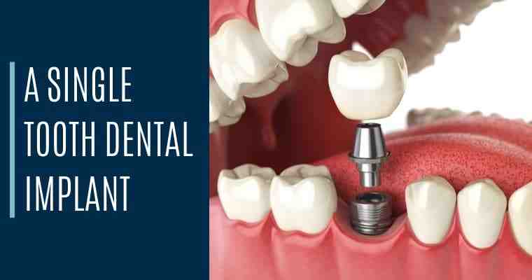 Who is the best dentist for dental implants?