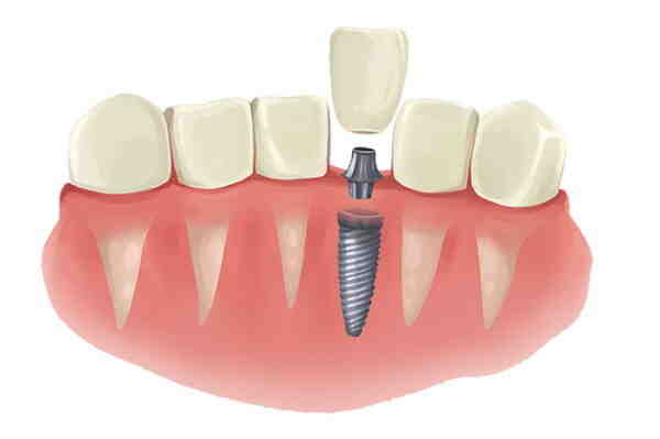 Are dental implants as good as real teeth?