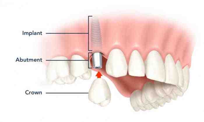Are dental implants covered by insurance?