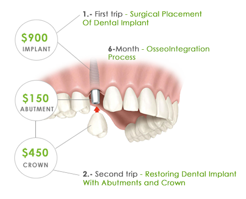 Are dental implants covered by insurance?