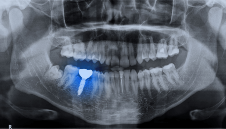 Are dental implants covered by medi-cal