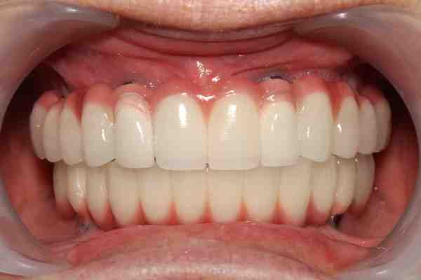 Are dental implants noticeable?