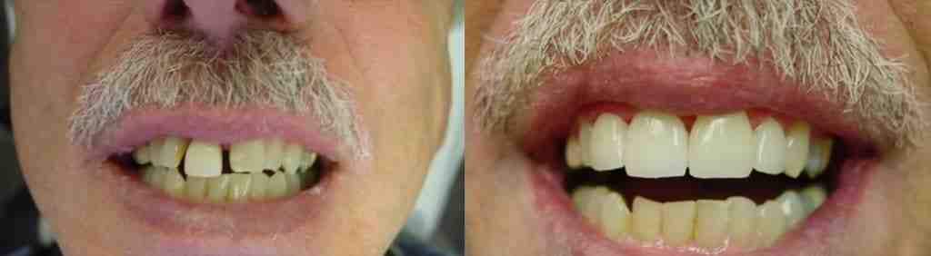 Are mini dental implants as good as regular implants?