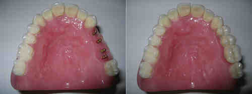 Are mini dental implants as good as regular implants?