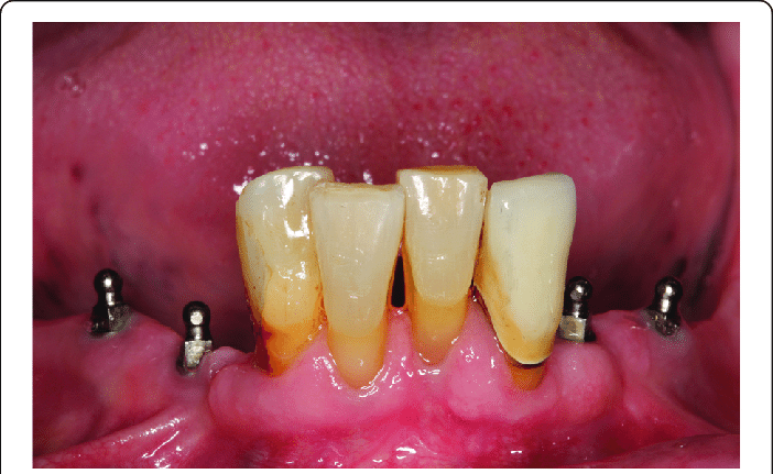 Are mini implants cheaper than regular implants?