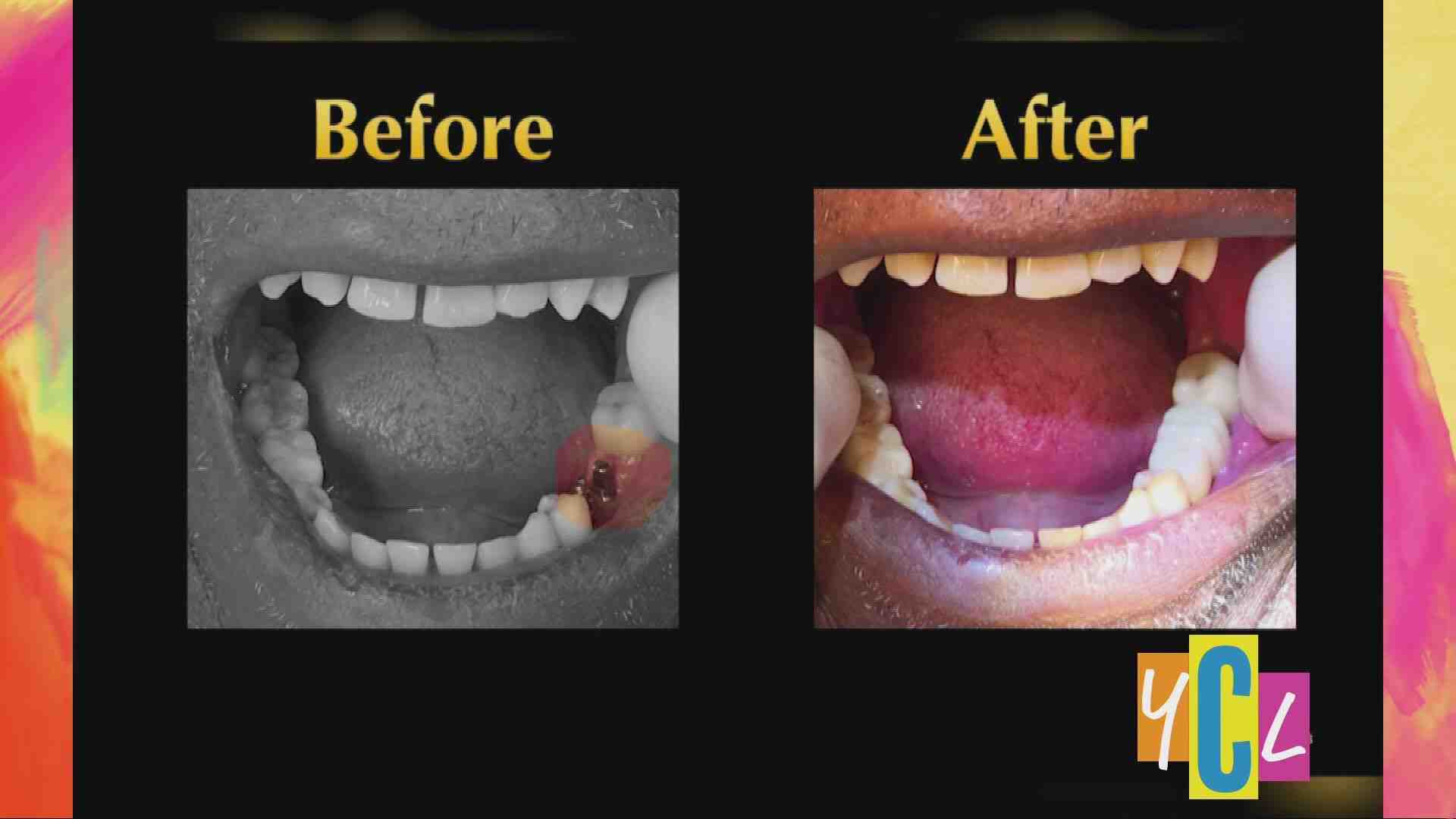 Are mini implants worth it?