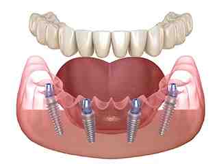 Can 1 Implant replace 2 teeth?