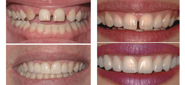 Can Cosmetic Dentistry fix crooked teeth?
