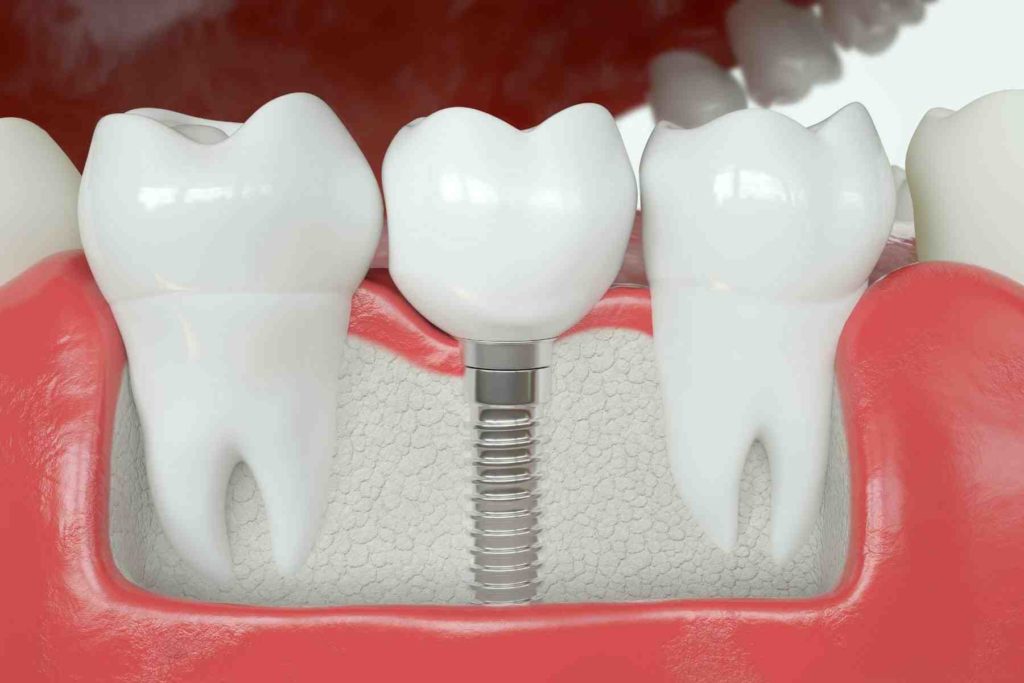 how-is-a-crown-attached-to-a-dental-implant-dental-news-network