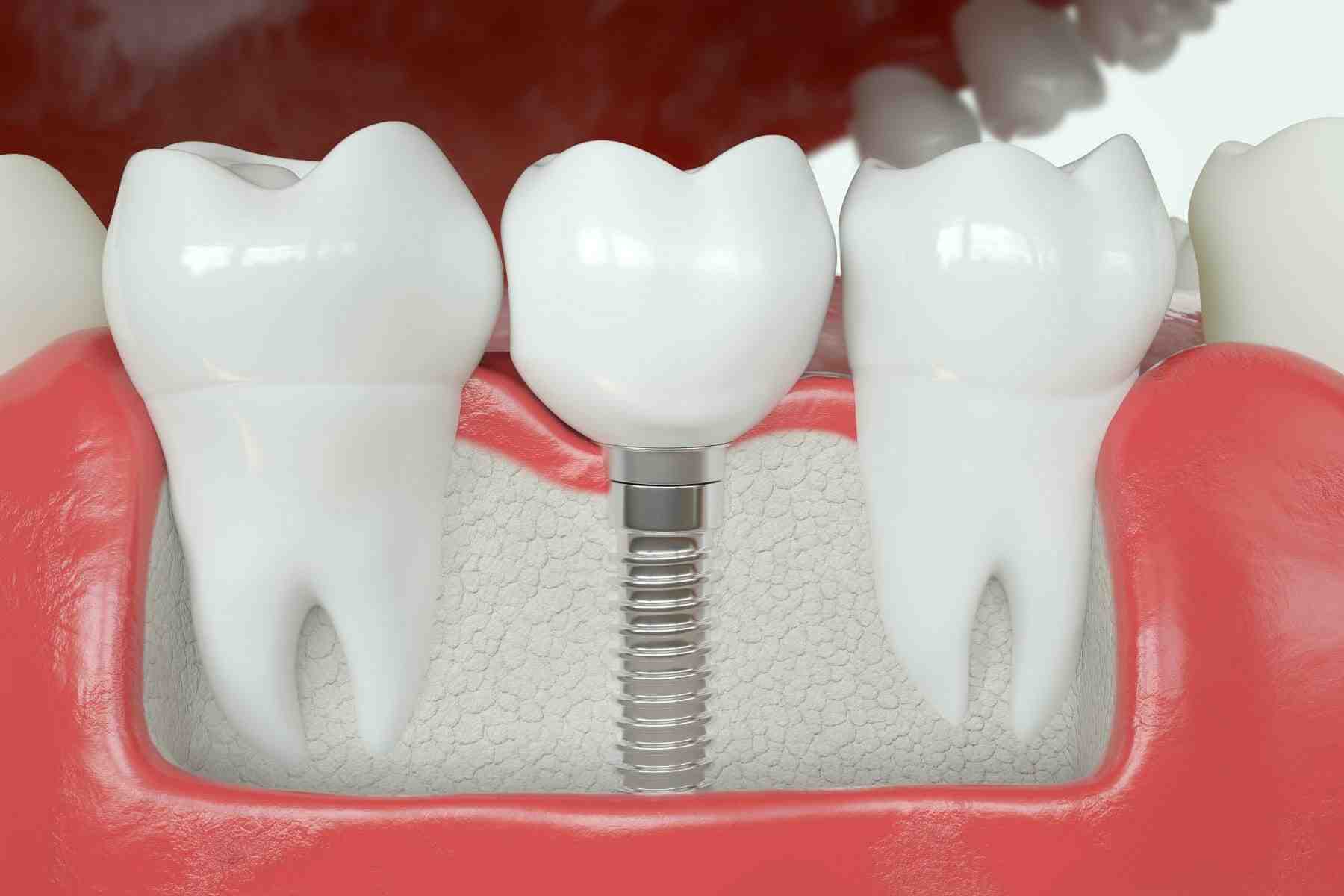 Can a crown fall off an implant?