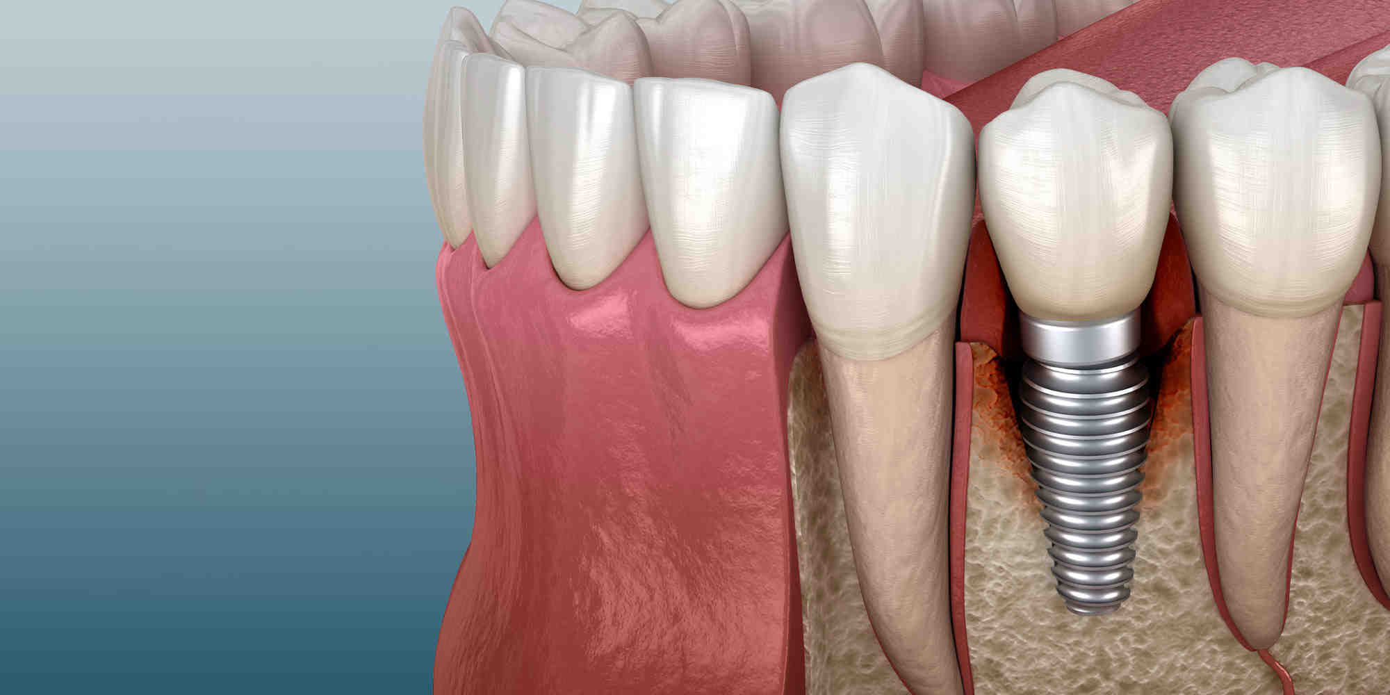 Can a failed dental implant be replaced?