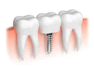 Can a failed dental implant be replaced?