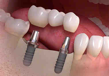 Can a failing dental implant be saved?
