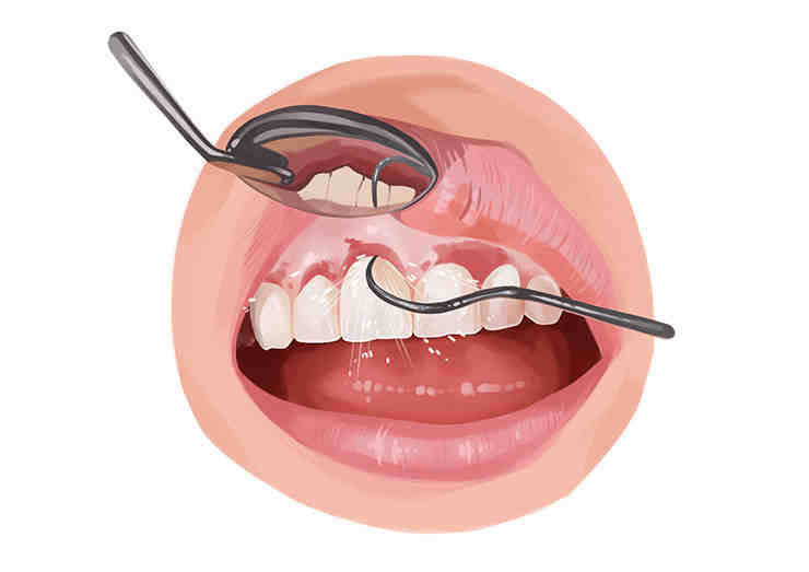 Can an infected dental implant be saved?