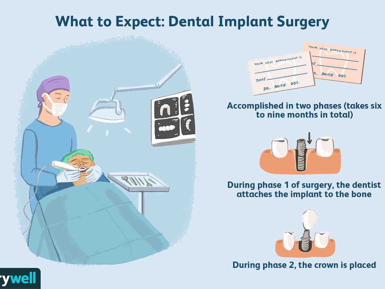 Can dental implants be done in one day?